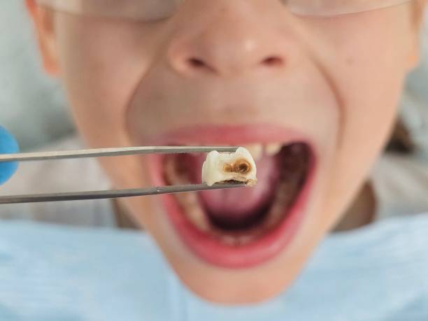 Best Root Canal Emergency Dentist  in Bevil Oaks, TX